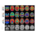 PET-Scan vom menschlichen Gehirn